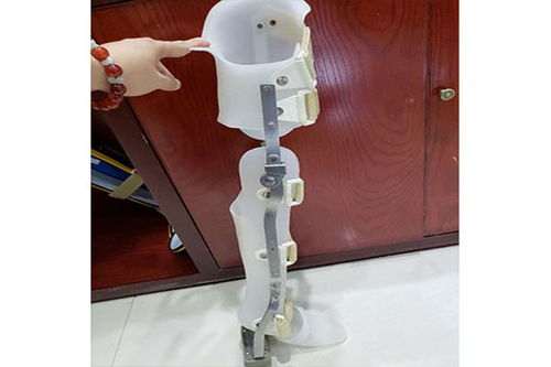 假肢與矯形器的使用周期與更換指南 科學維護，保障生活品質